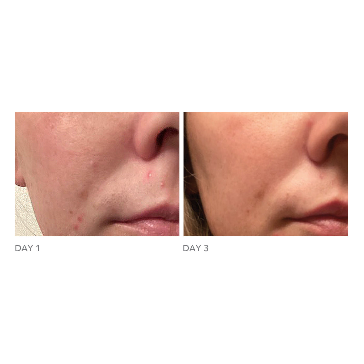 DRx Blemish Solutions™ Acne Eliminating Gel